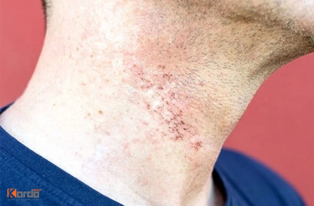 جلوگیری از جوش بعداز اصلاح صورت