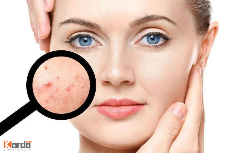 جوش زیر پوستی و راهکارهای درمان آن